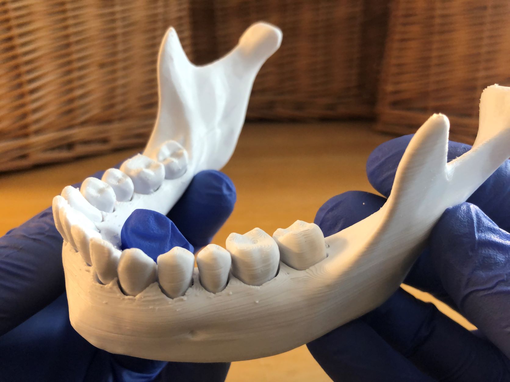 Loose Teeth