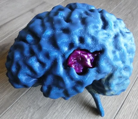 MRI Brain