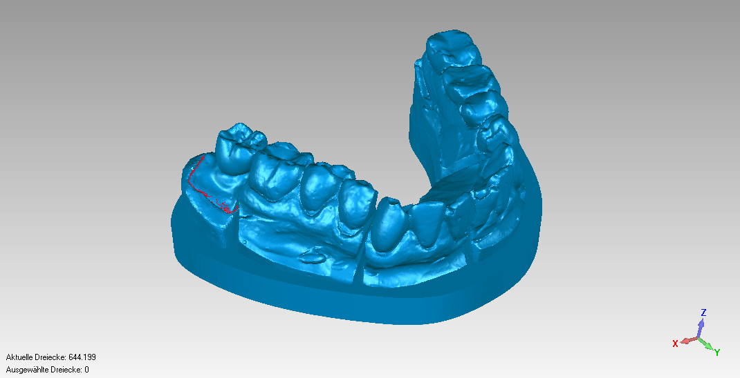 implant-supported crown