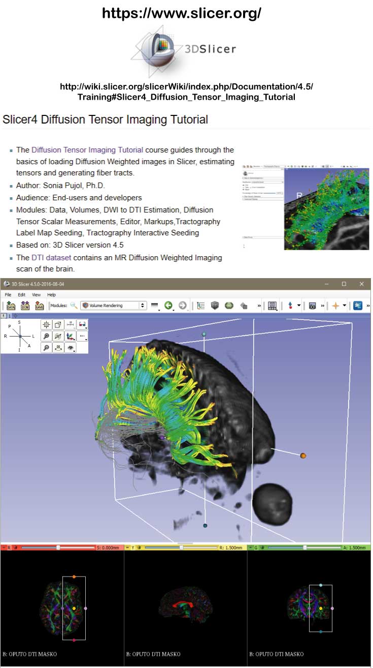 Printable Diffusion MRI analysis Brain tracts