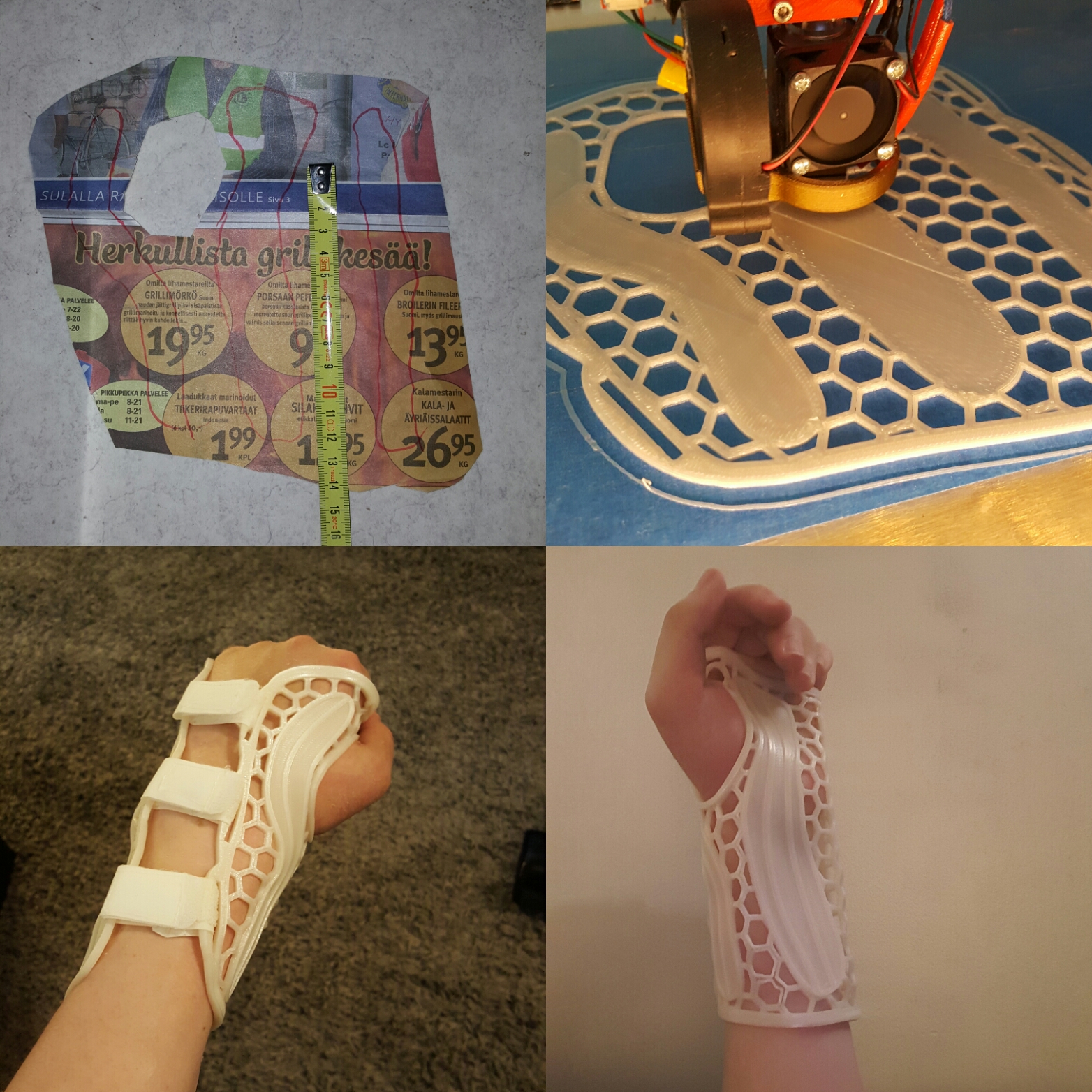 Wrist brace for 5th metacarpal fracture