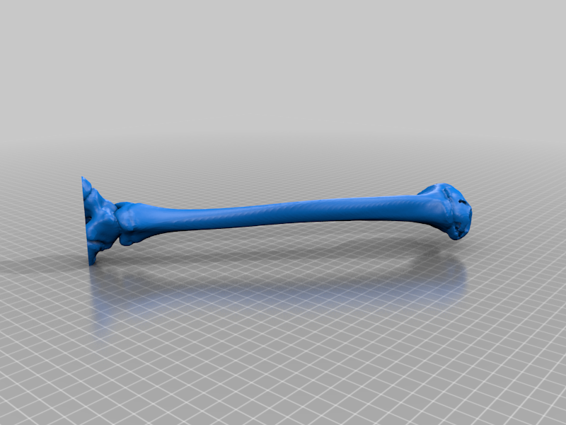High-Precision 3D Model of Adolescent Tibia Vara - Detailed Orthopedic Educational Tool