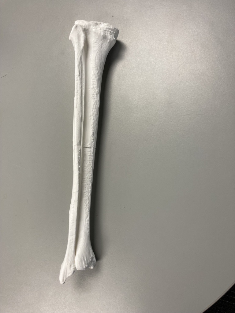 Tibia and Fibia split into 2 Parts