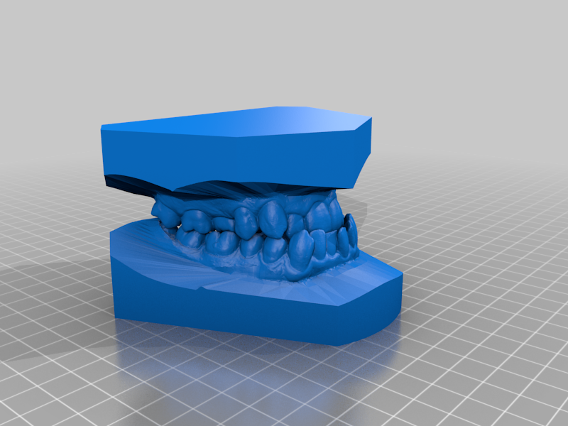My class III Malocclusion (underbite)