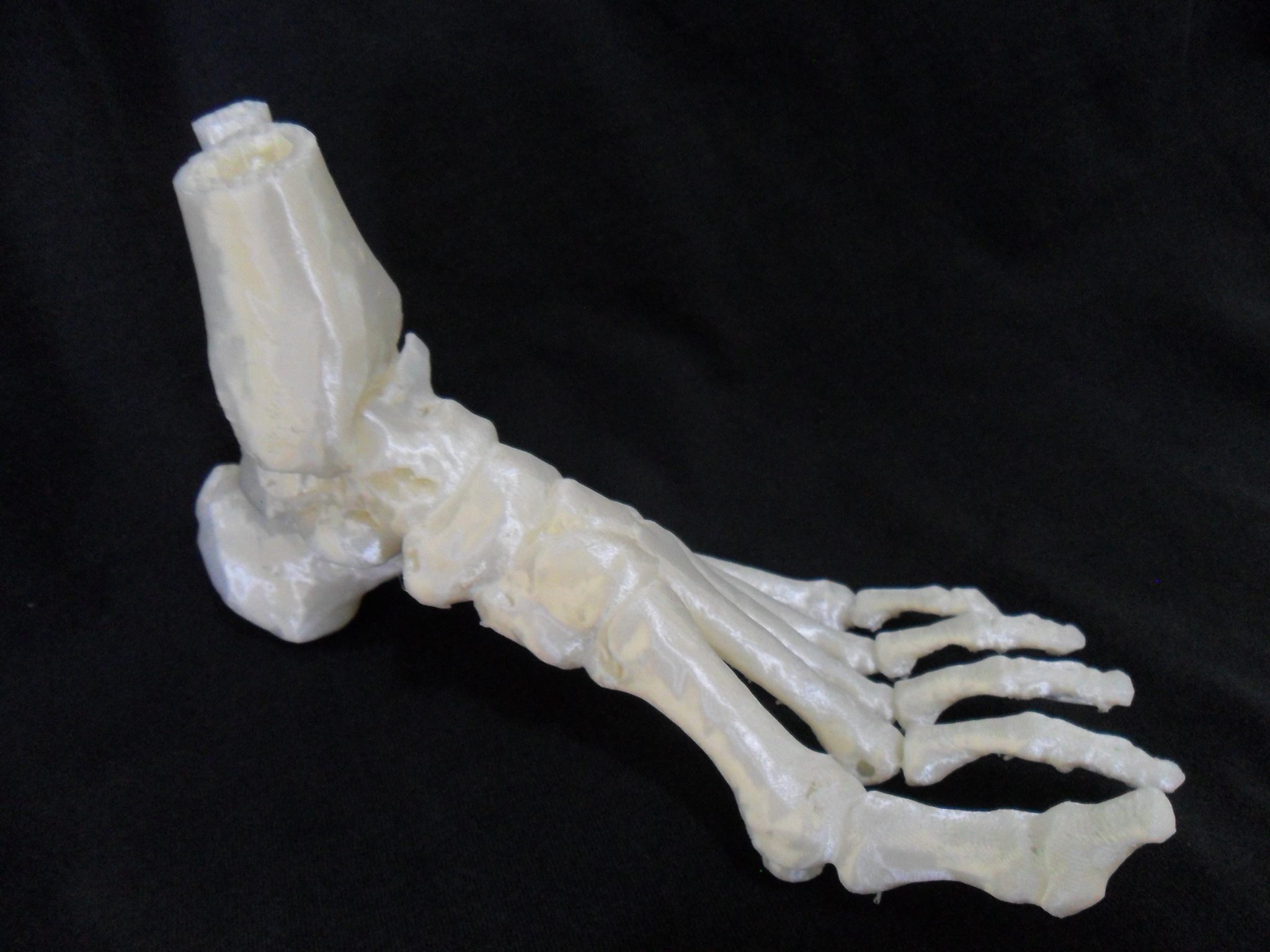 Ankle - Talus fracture