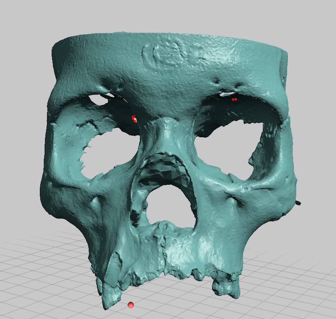 Partial Human Skull, Asian Ancestry, Facial Region Scan