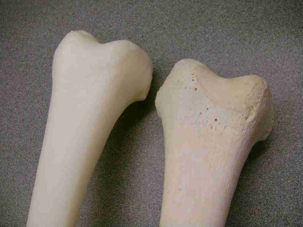 Right Femur