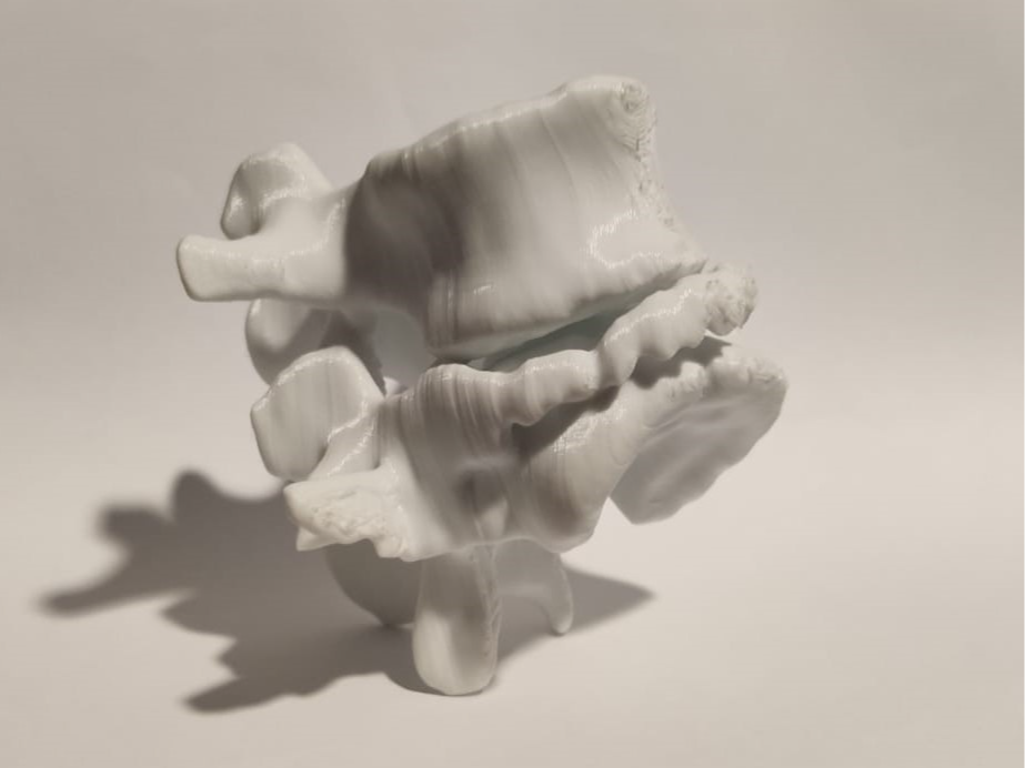 Vertebra Trauma