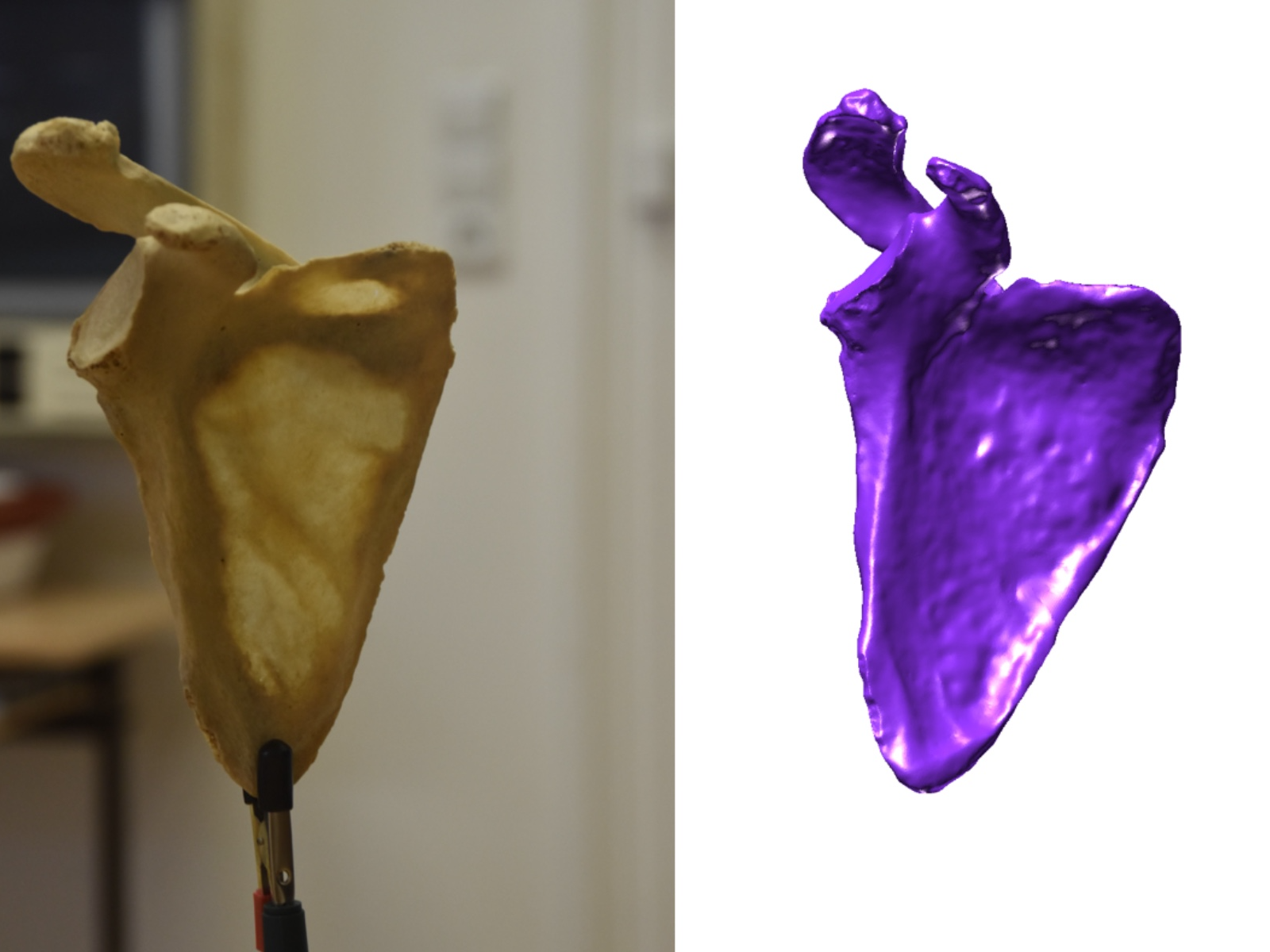 Shoulder Blade Scan - Scapula (R)