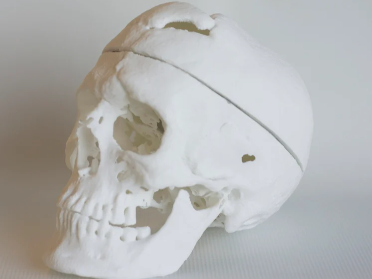 Phineas Gage Skull