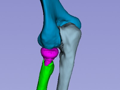 Protesis de cupula radial (TAC de Codo)
