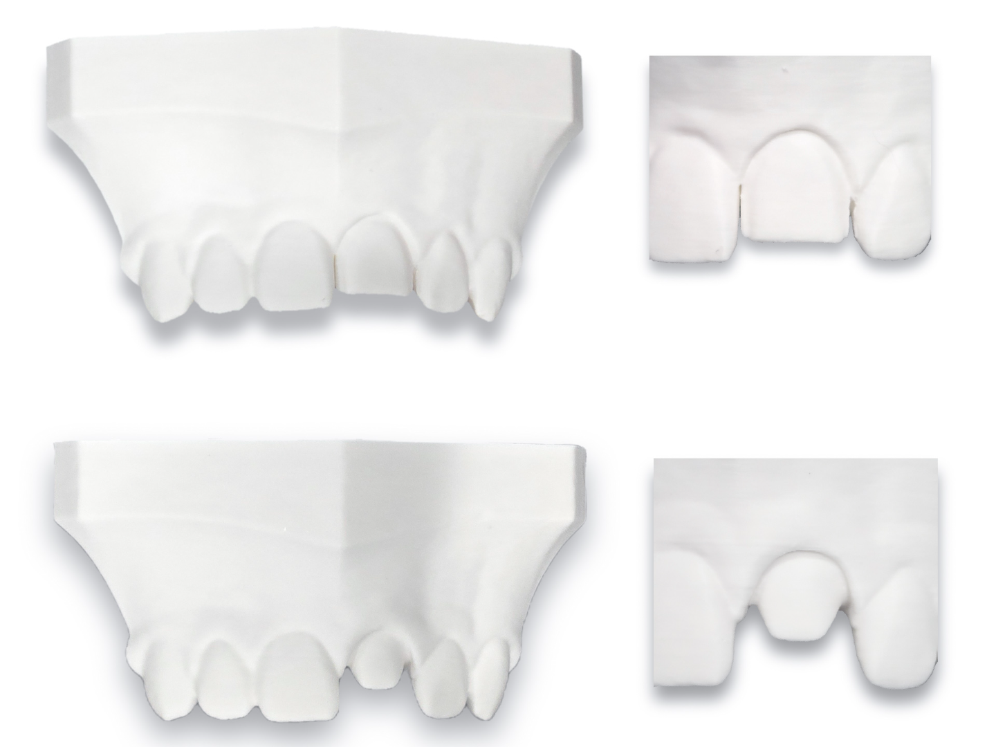 Anterior Crown Prep vs Veneer Prep Demo Model