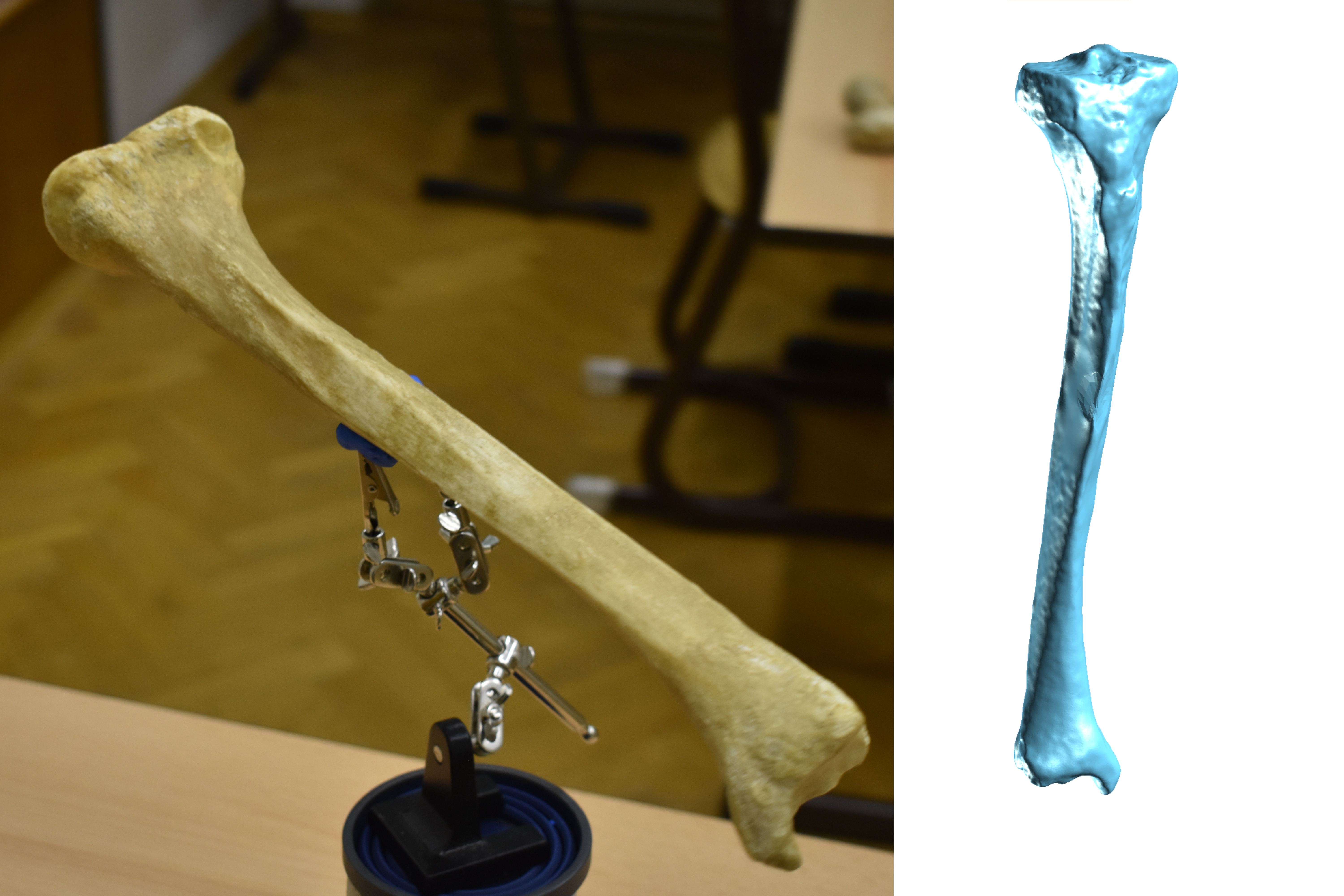Shinbone Scan - Tibia (R)