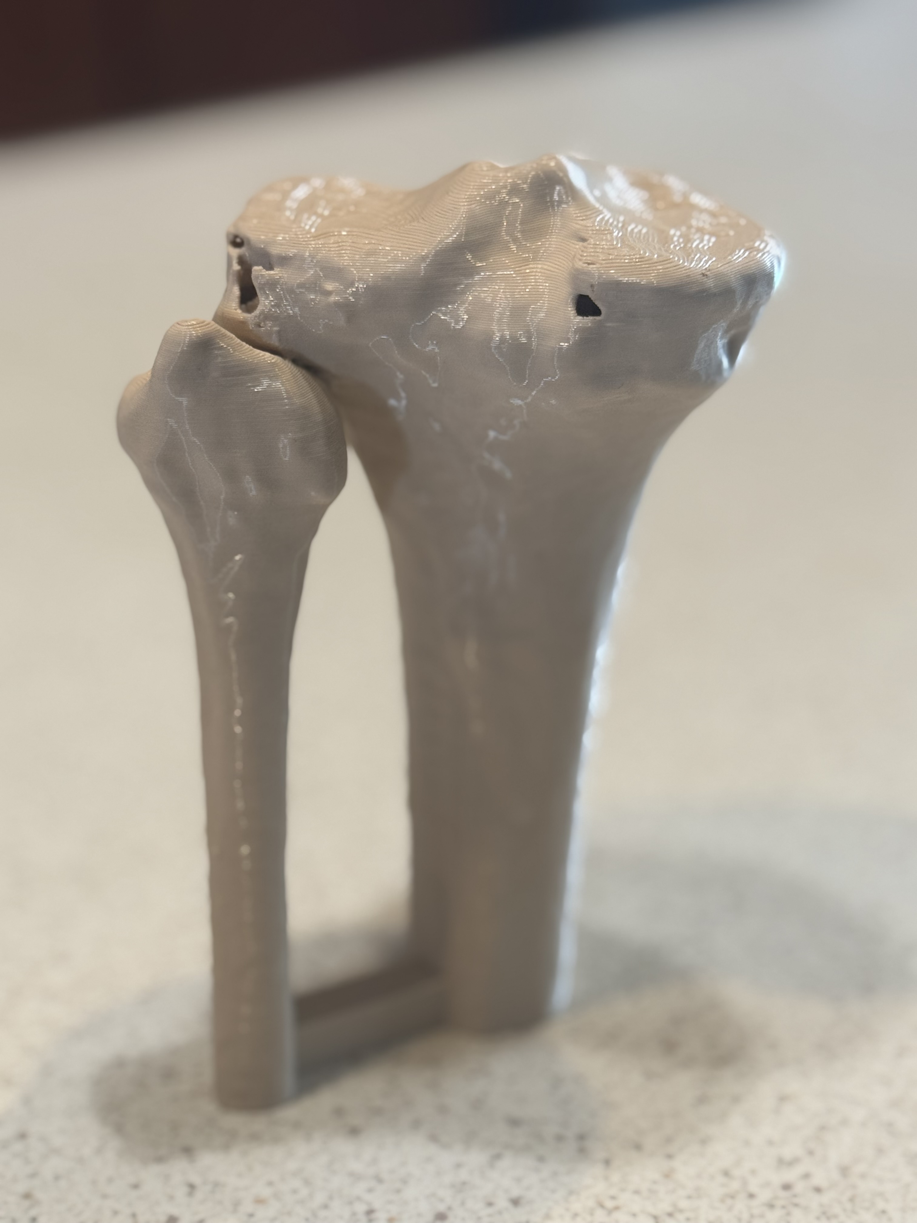 Proximal tibia and fibula