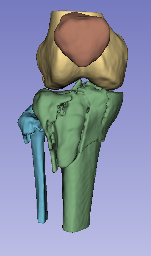Tibia Fibula Fracture